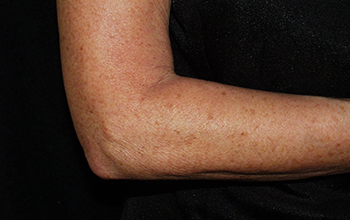 After, image of the firm skin on womens arm